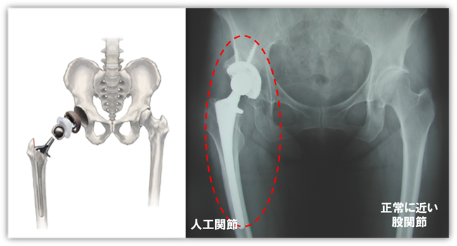 人工関節センターの紹介