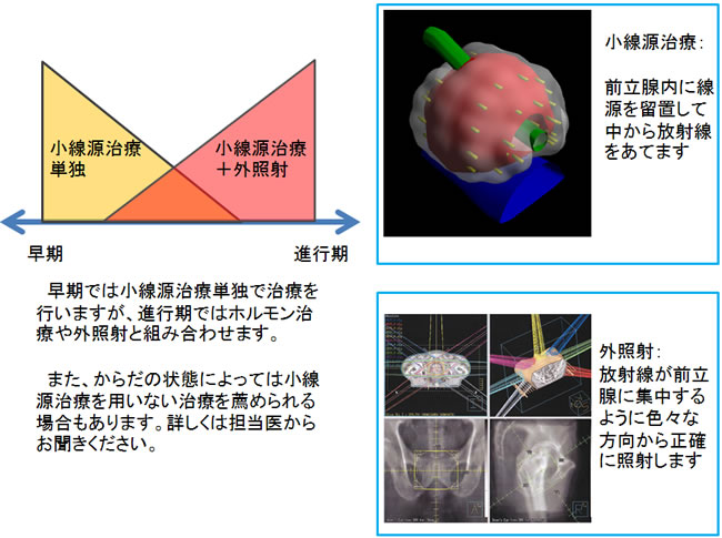 小線源治療