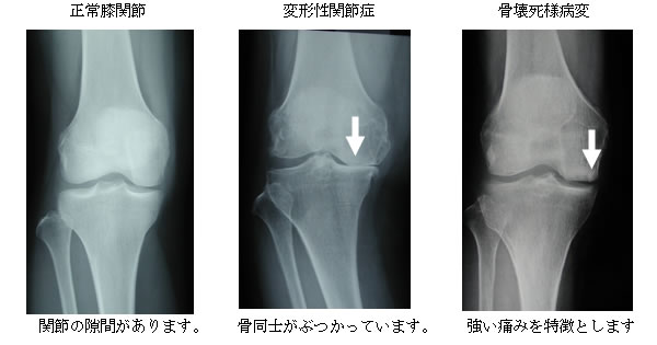正常膝関節・変形性関節症・骨壊死様病変